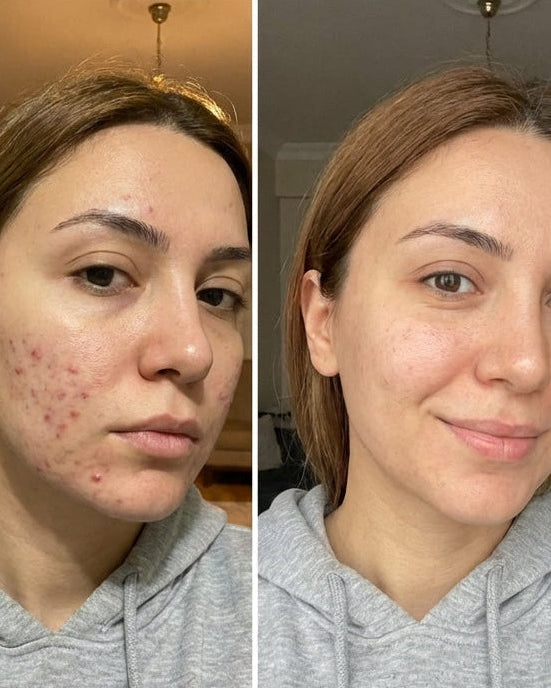 Zerdeçal İçeren Nazik Peeling Pedleri  & Cildiniz Parlasın